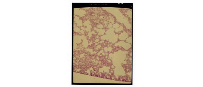 Ensemble de six négatifs photographiques visualisant des hémorragies au microscope - Prima edizione - Edition-Originale.com